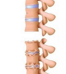 Etape de rampe de osteochondroză a gâtului