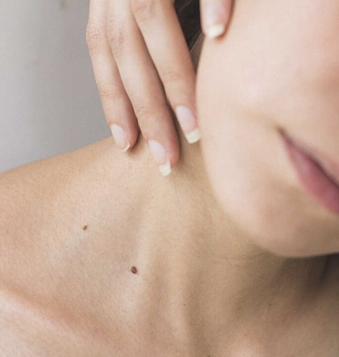 Rigiditatea gâtului este unul dintre simptomele stadiului inițial al osteocondrozei coloanei cervicale.