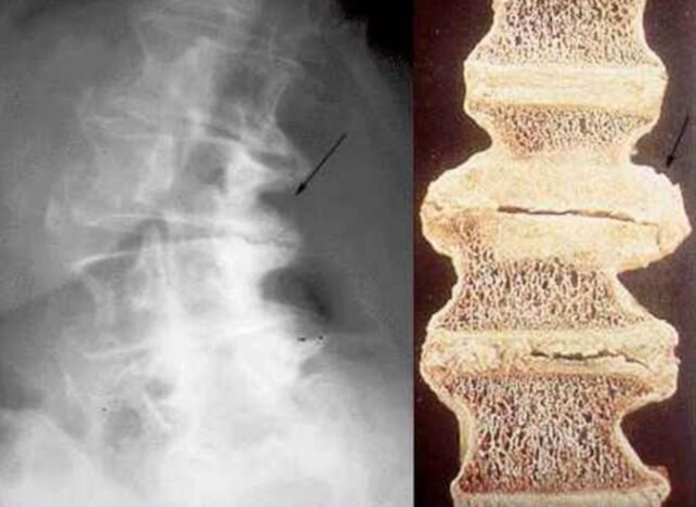 afectarea vertebrelor în osteocondroza toracică
