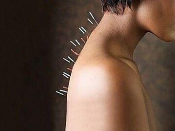Reflexoterapia este o metodă eficientă de tratare a osteocondrozei cervicale