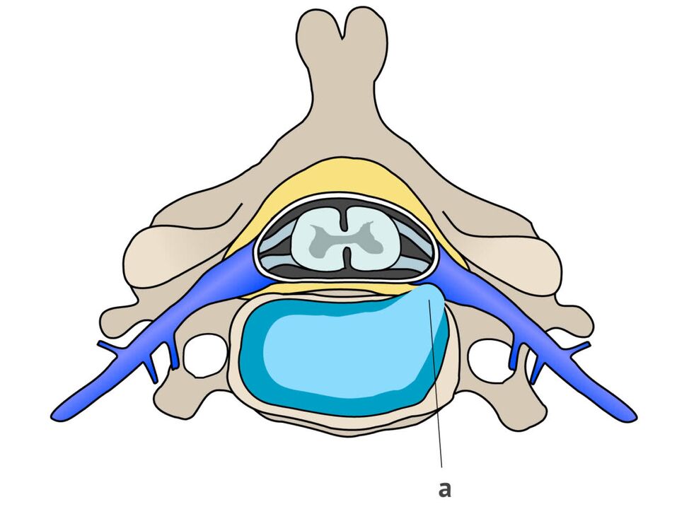 hernie intervertebrală cu osteocondroză cervicală